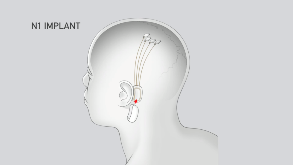 Схема имплантации, иллюстрация Neuralink